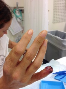 CALO - still healing